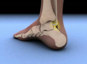  Heal Your Sprained Ankle Fast
